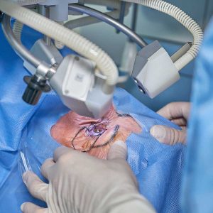 Glaucoma Surgery Cost in the Philippines (2025 Guide)