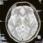 Is-Glaucoma-a-brain-disease