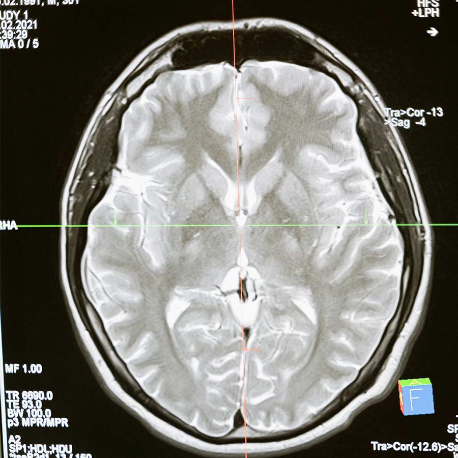 Is-Glaucoma-a-brain-disease