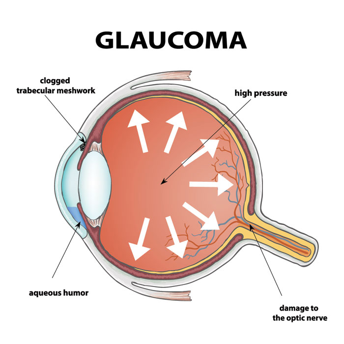 eye anatomy of glaucoma