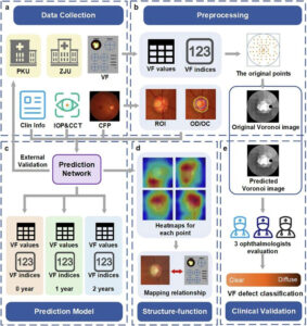 AI Tracks Glaucoma Progress Using Eye Images