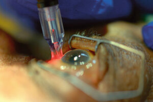 Laser Cyclophotocoagulation (CPC) in the Philippines