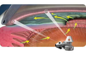 MIGS: Minimally Invasive Glaucoma Surgery in the Philippines