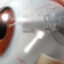 Tube Shunt Surgery in philippines