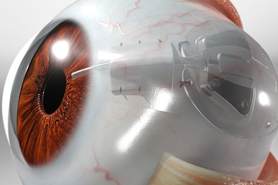 Tube Shunt Surgery in philippines