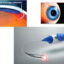 canaloplasty surgery in the Philippines
