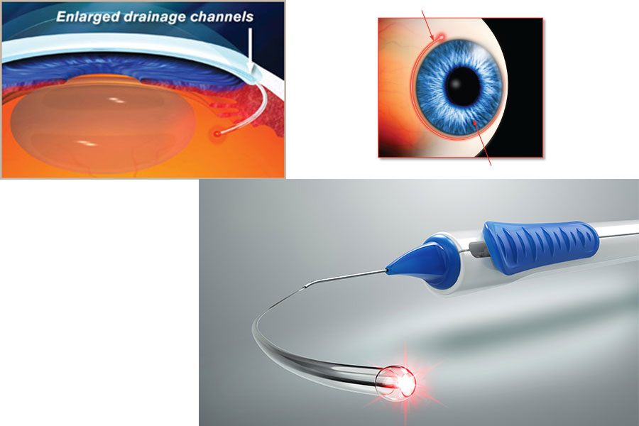 canaloplasty surgery in the Philippines