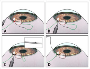 Canaloplasty Surgery