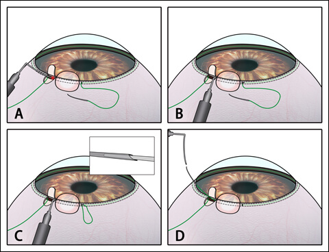 Canaloplasty Surgery