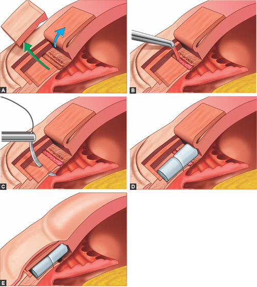 Deep Sclerectomy Surgery in the U.S.