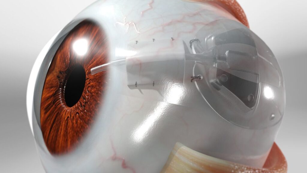 Glaucoma Tube Shunt Surgery in US