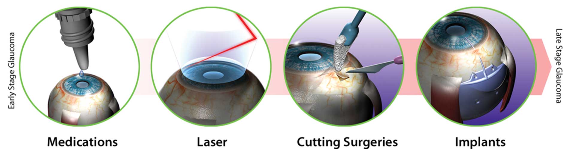 UK Glaucoma Surgery