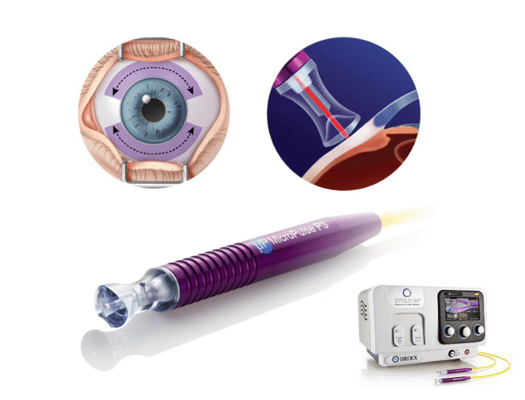 Laser Cyclophotocoagulation CPC in Germany 2025