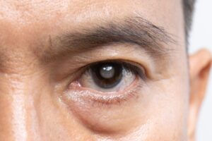 glaucoma philippines