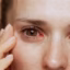 Buying Eye Drugs Without Rx Risky Optometrist Warns
