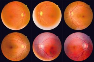 Eye Photos May Detect Chronic Health Problems Early