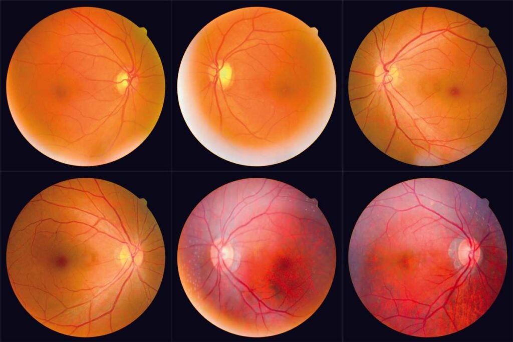 Eye Photos May Detect Chronic Health Problems Early
