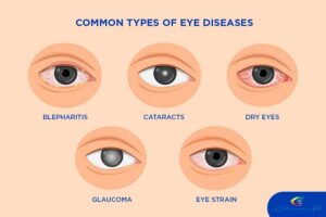 Hub shares new insights on eye disease awareness