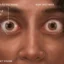 Teprotumumab for thyroid eye disease explained