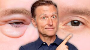 Under-Eye Puffiness: Could It Signal Kidney Issues?