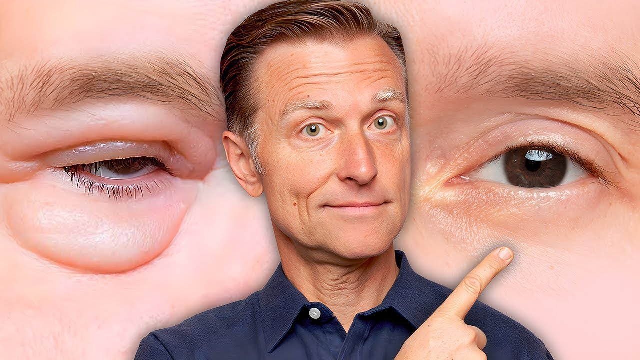 Under-Eye Puffiness: Could It Signal Kidney Issues?