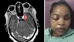 Builder, 61, Hails UK-First Eye Displacement Brain Surgery