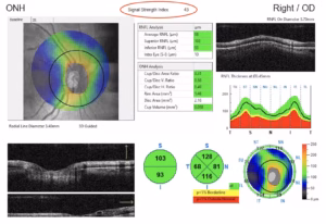 Dry Eye Disease Reduces OCT Image Quality