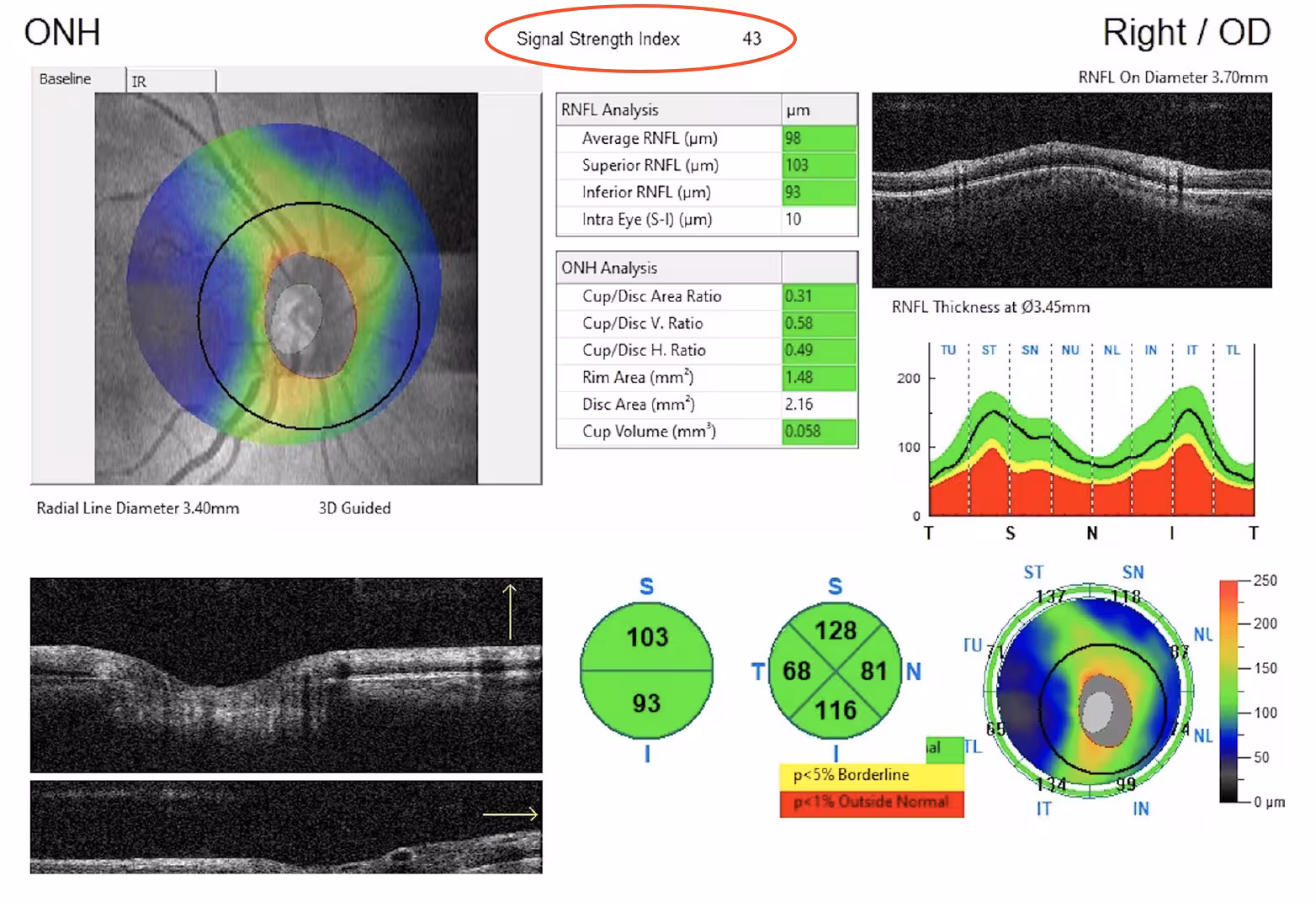 Dry Eye Disease Reduces OCT Image Quality