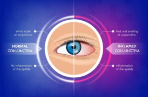Eye Doctor Reveals 6 Causes of Persistent Irritation