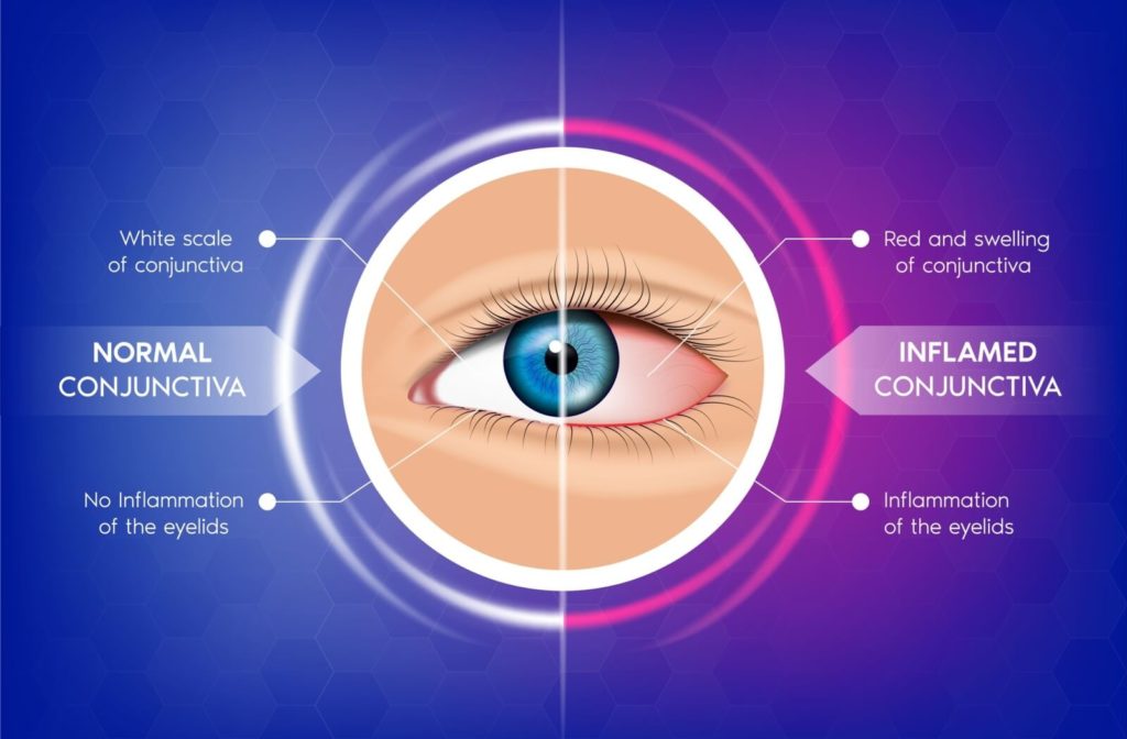Eye Doctor Reveals 6 Causes of Persistent Irritation