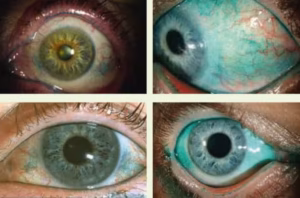 EyeWorld Weekly: Retina, Glaucoma & Cornea Updates