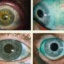 EyeWorld Weekly Retina, Glaucoma & Cornea Updates
