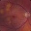 Glaucoma Eye Problem