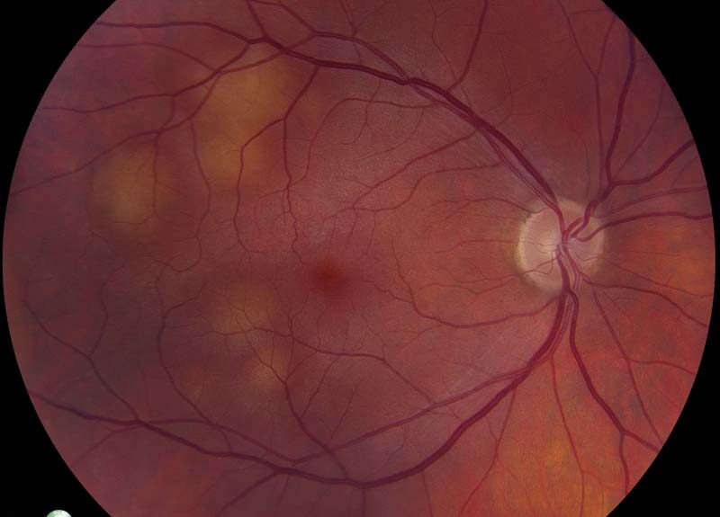 Neovascular Glaucoma From Lung Cancer Eye Metastasis