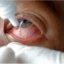 Self-Prescribing Eye Drops May Worsen Eye Disease
