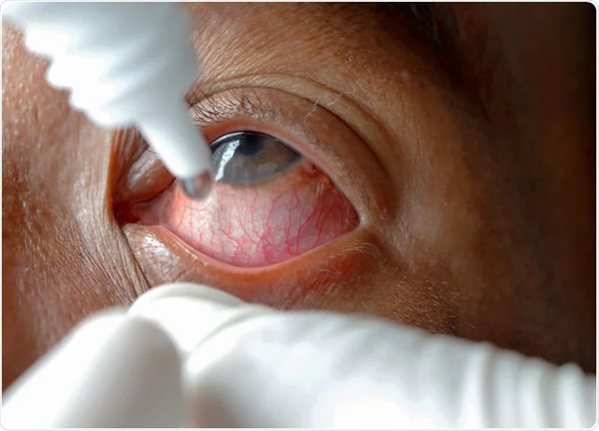 Self-Prescribing Eye Drops May Worsen Eye Disease
