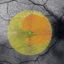 Sight Loss Tool Forecasts Surge in Eye Disease Cases