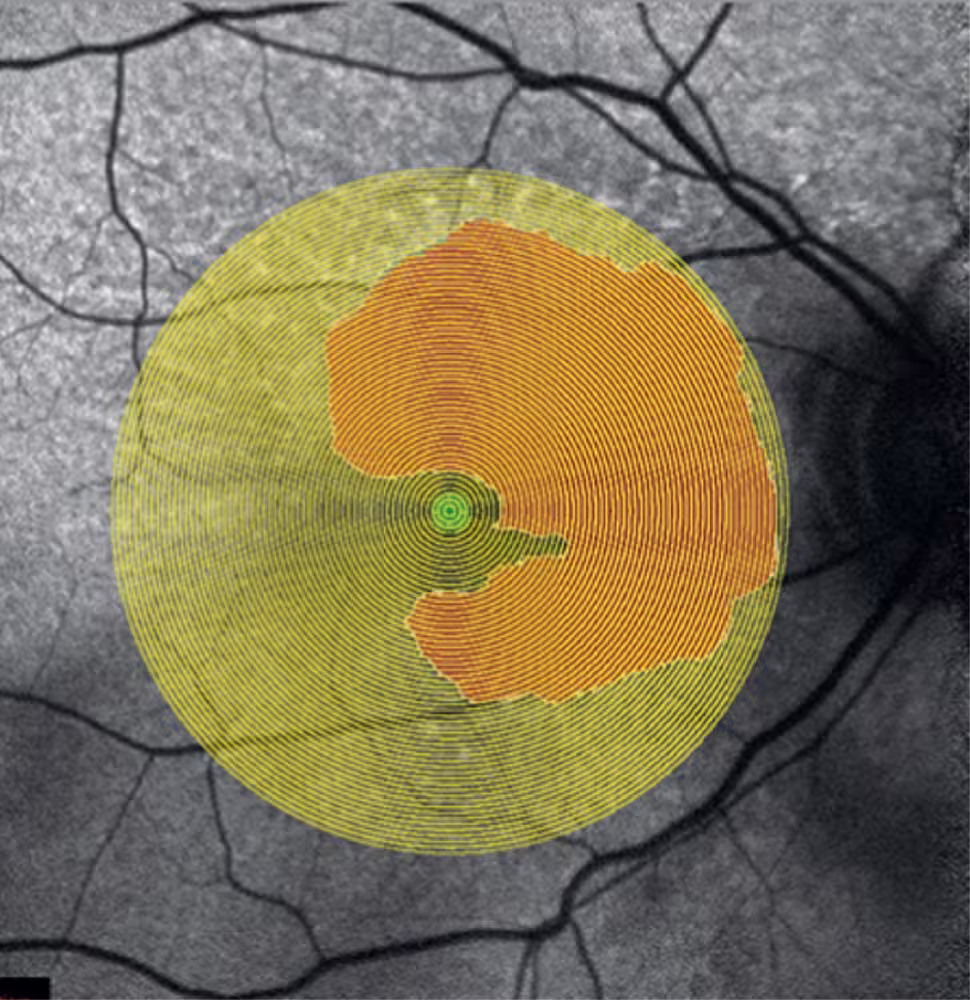 Sight Loss Tool Forecasts Surge in Eye Disease Cases