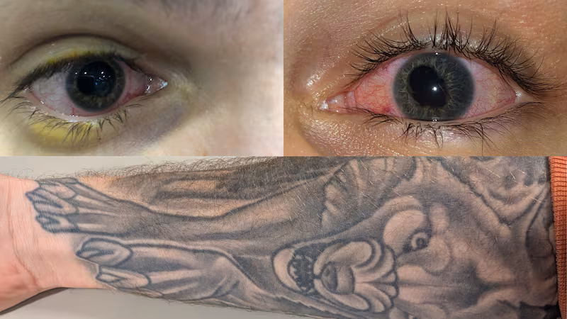 Tattoo-Linked Vision Problems Raise Health Concerns
