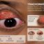 Glaucoma Eye Problem