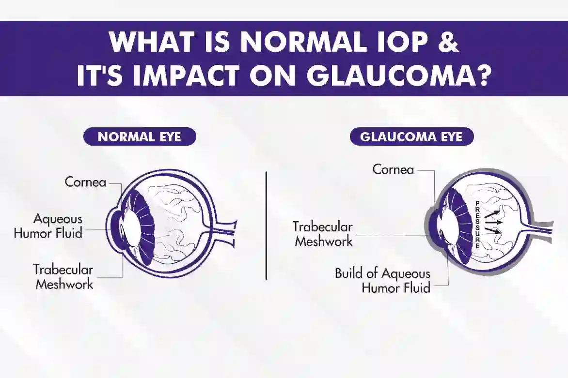 Ambient temperature and eye pressure in glaucoma patients