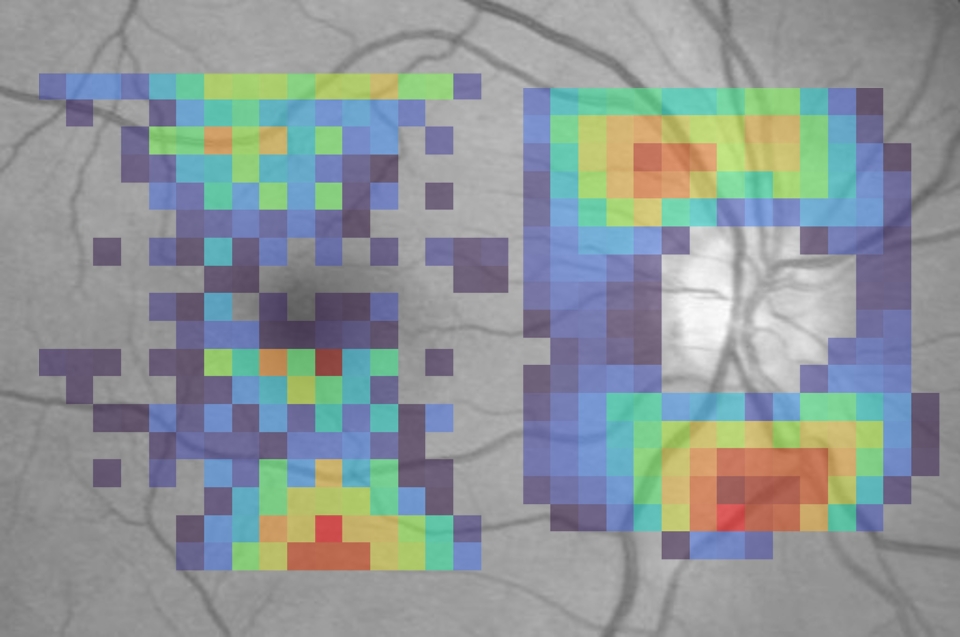 Artificial intelligence transforming glaucoma detection and care