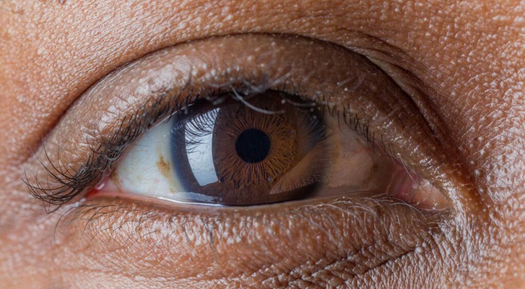 Breakthrough-Eye-Pressure-Monitoring-Reveals-Glaucoma-Clues