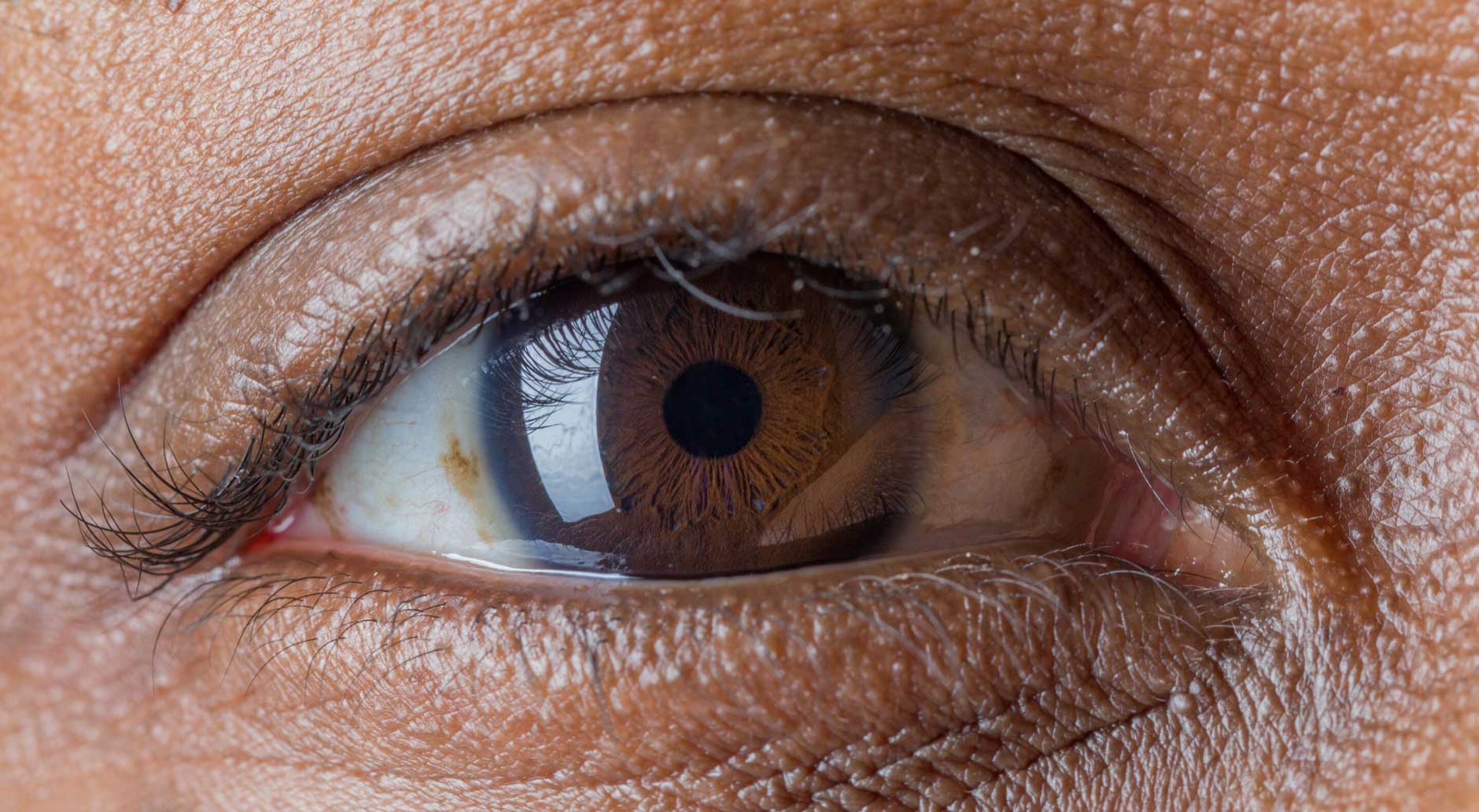Breakthrough-Eye-Pressure-Monitoring-Reveals-Glaucoma-Clues