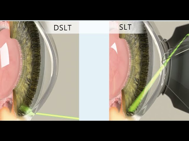 Direct Selective Laser Trabeculoplasty for Glaucoma Treatment