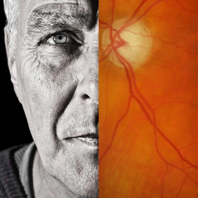 New Zealand glaucoma care shows progress, yet gaps in treatment remain
