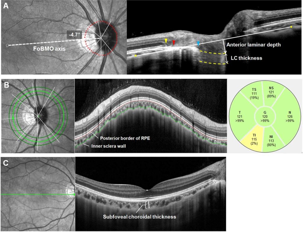 Parapapillary-Atrophy-Changes-Signal-Risk-in-Angle-Closure