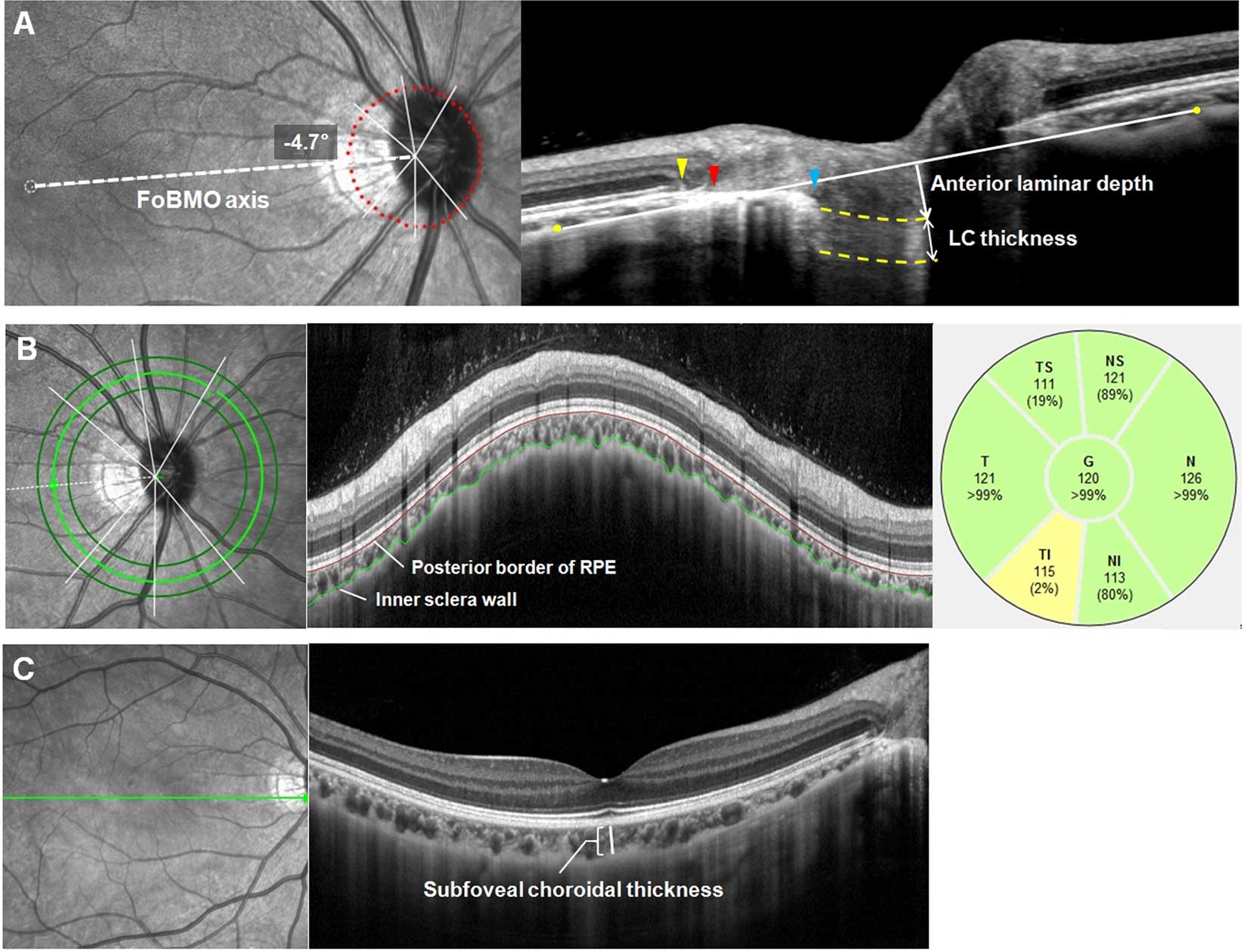 Parapapillary-Atrophy-Changes-Signal-Risk-in-Angle-Closure