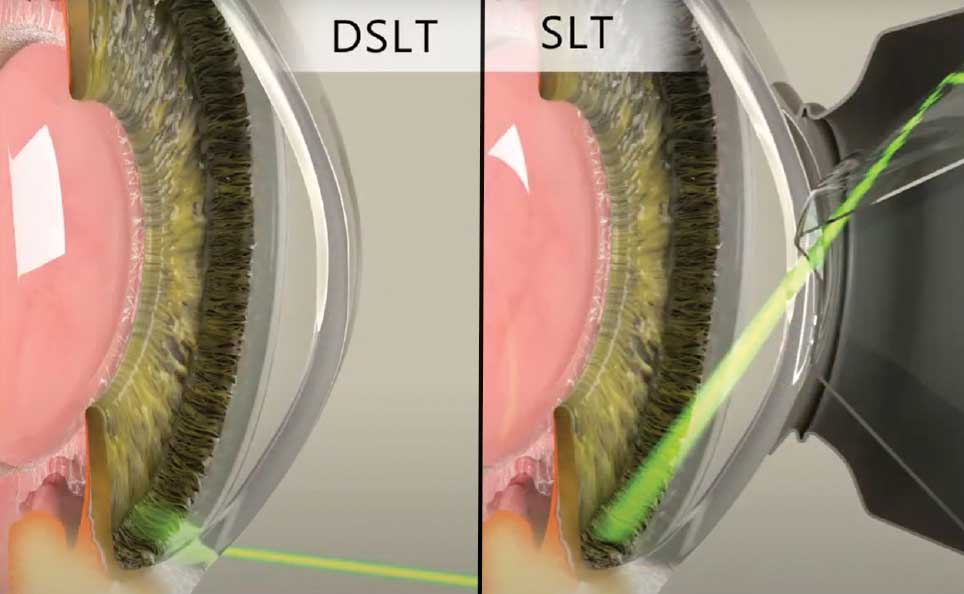 SLT-vs-DSLT-Comparing-Laser-Glaucoma-Treatment-Outcomes
