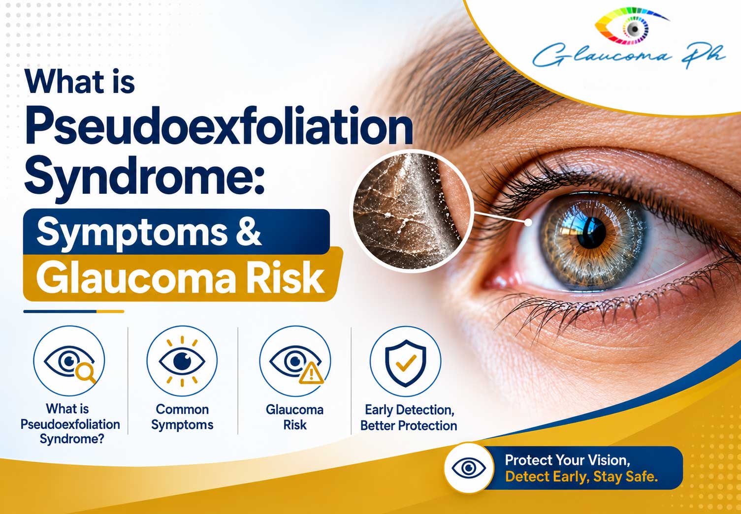 Understanding-Pseudoexfoliation-Syndrome